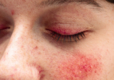 Demodex Mites and Rosacea: Treatment Methods and Causes