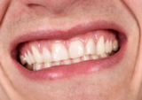 Dentist For Gum Disease Treatment In West Chester PA